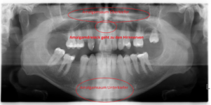opg Sauerzweig oktober 2020 nach amalgamentfernung.png