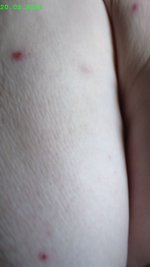 Pusteln aus 24.04.2021.jpg Pusteln aus 24.04.2021.jpg